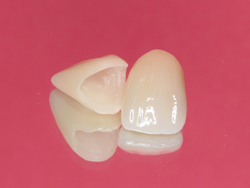 審美修復(ノンメタルデンティストリイ)